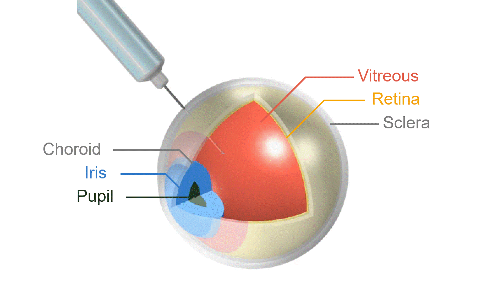 CFD simulation of intravitreal ocular injection