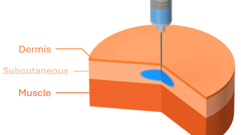 CFD simulation of subcutaneous injection.