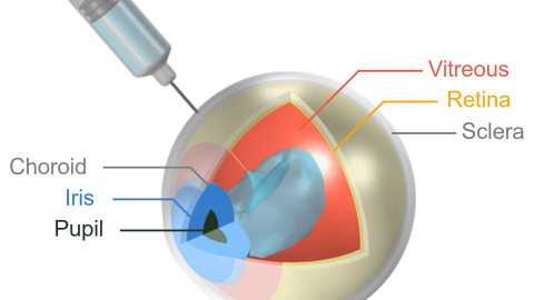 CFD simulation of intravitreal ocular injection