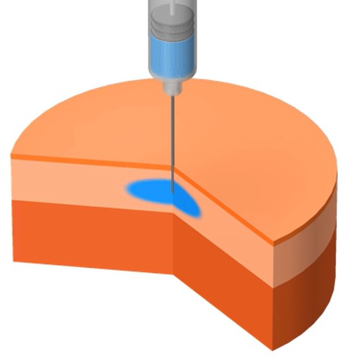 Simulation of subcutaneous injection: a needle delivers a drug bolus (blue) into the subcutaneous tissue layer beneath the skin.